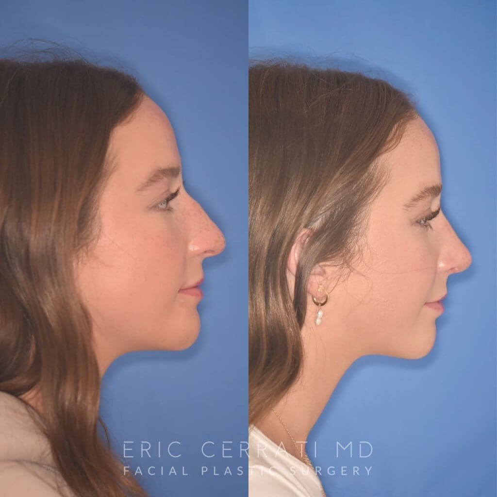 patient before and after rhinoplasty procedure