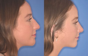 patient before and after rhinoplasty procedure
