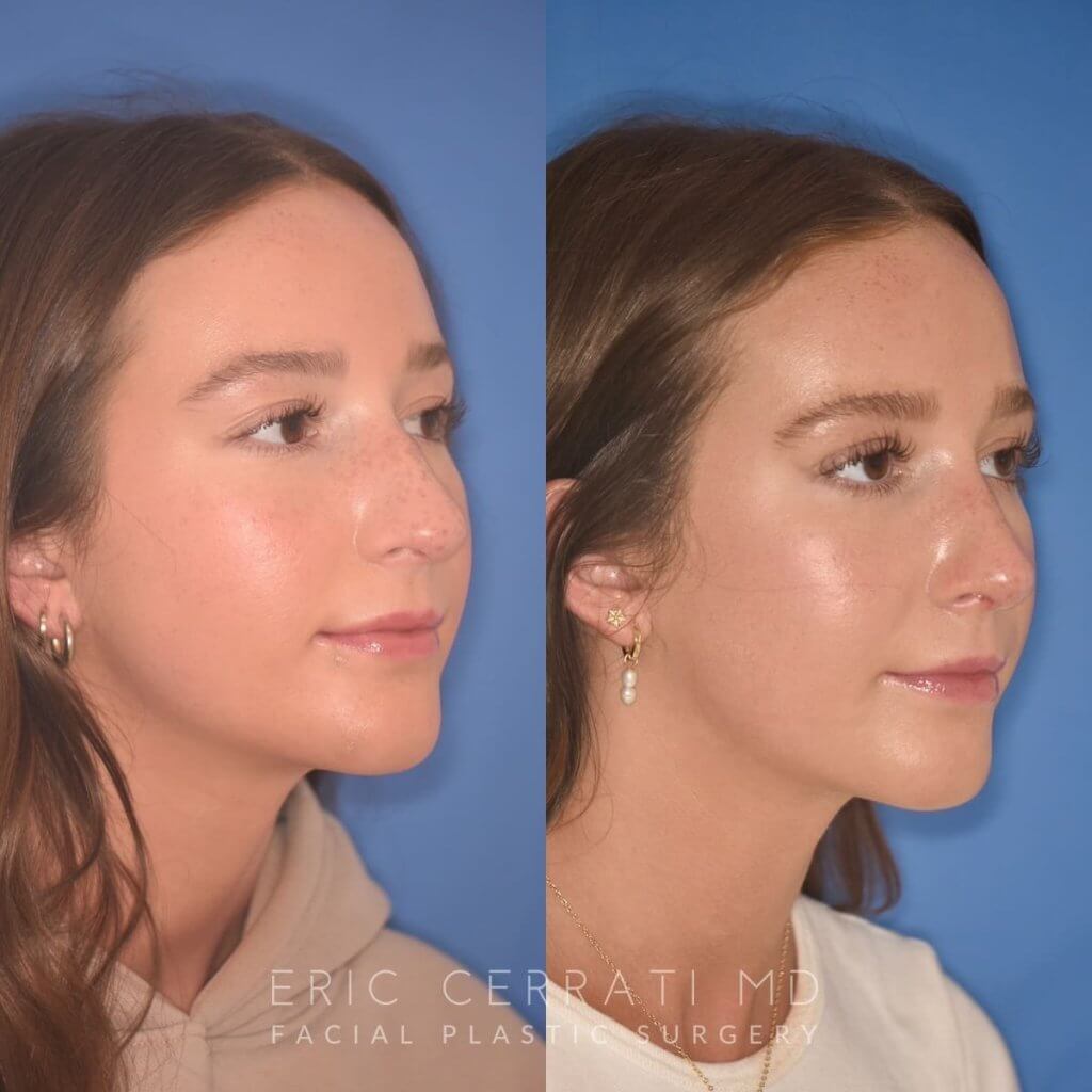 patient before and after rhinoplasty procedure