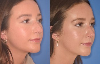 patient before and after rhinoplasty procedure