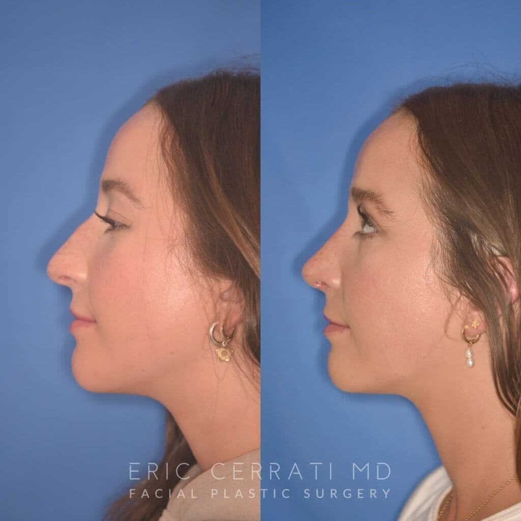 patient before and after rhinoplasty procedure
