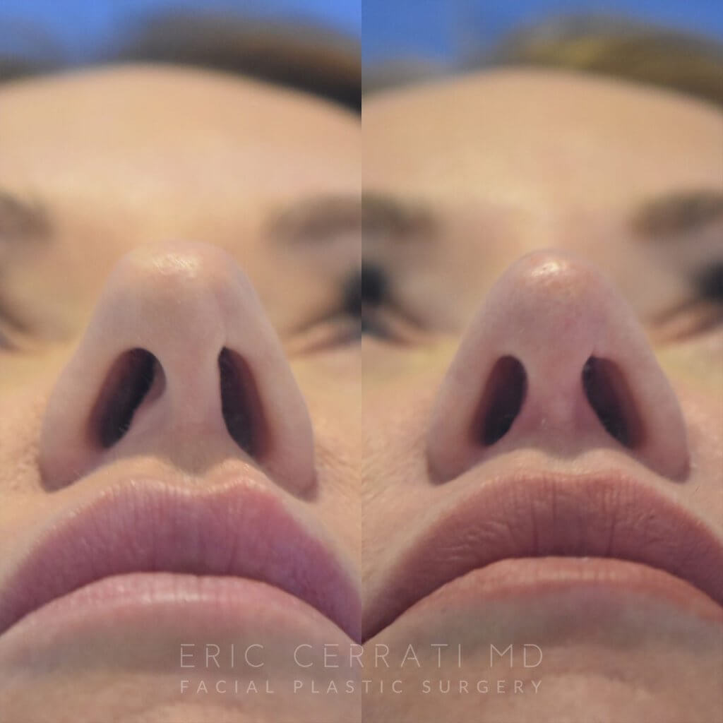 49 YR - 3 Months Postop: Upper Blepharoplasty, Lower Blepharoplasty, Rhinoplasty