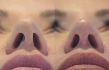 49 YR - 3 Months Postop: Upper Blepharoplasty, Lower Blepharoplasty, Rhinoplasty