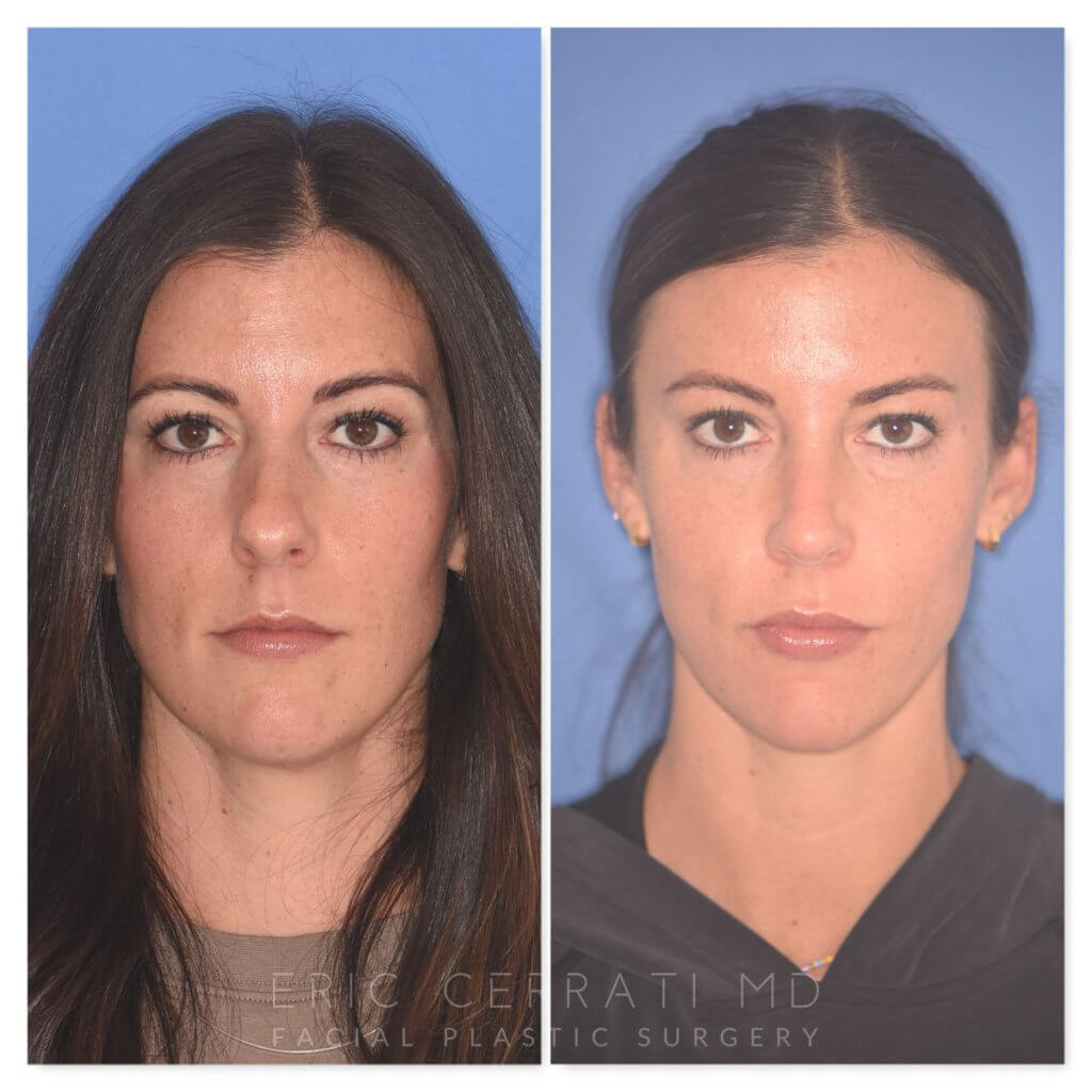 patient before and after rhinoplasty procedure