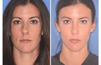 patient before and after rhinoplasty procedure