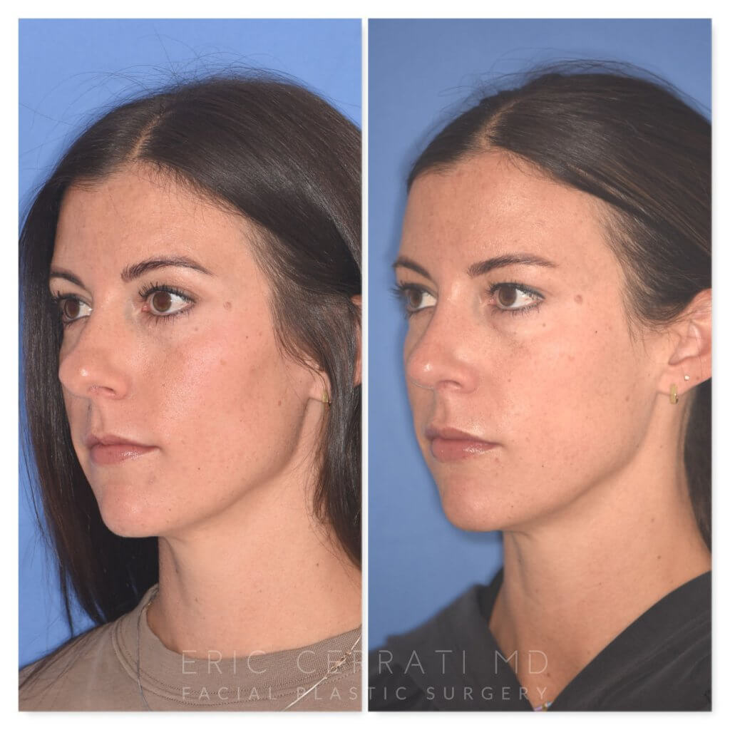 patient before and after rhinoplasty procedure