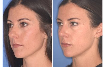 patient before and after rhinoplasty procedure