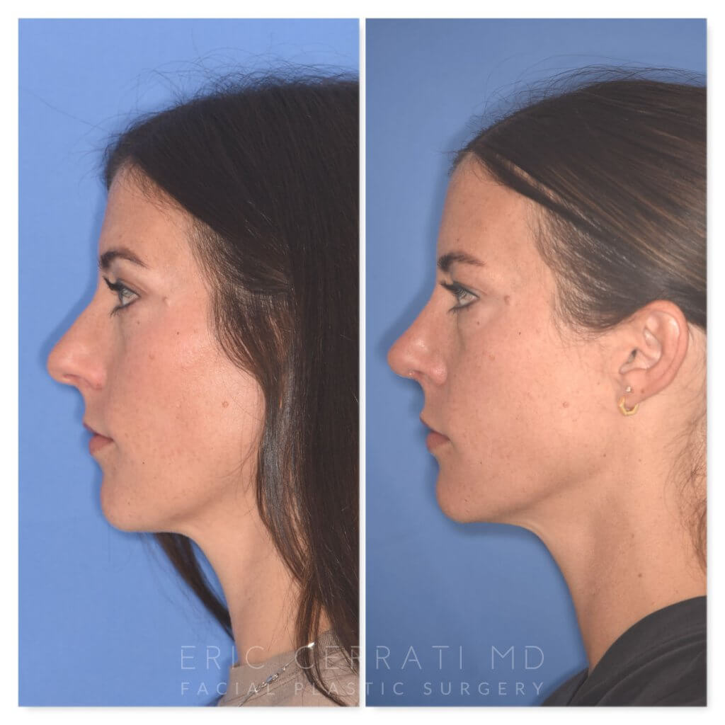 patient before and after rhinoplasty procedure