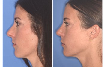 patient before and after rhinoplasty procedure