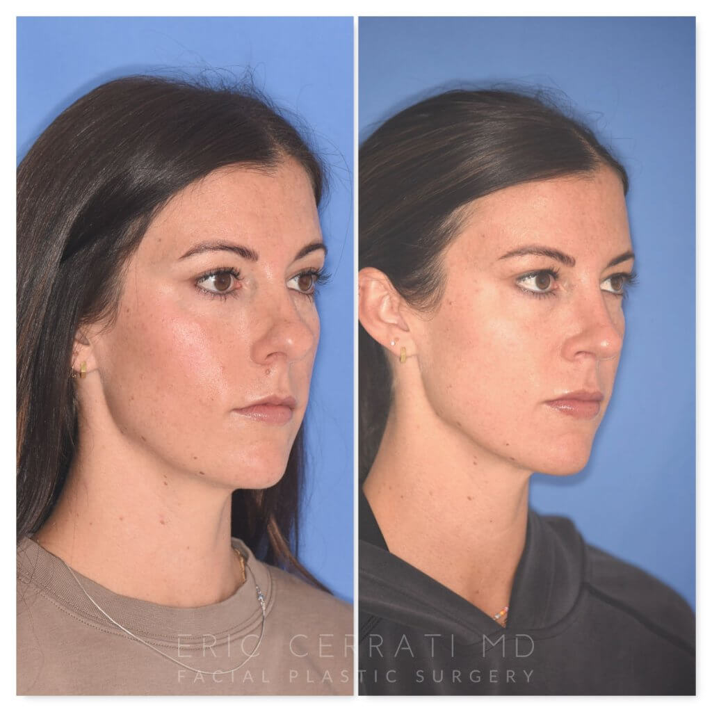 patient before and after rhinoplasty procedure