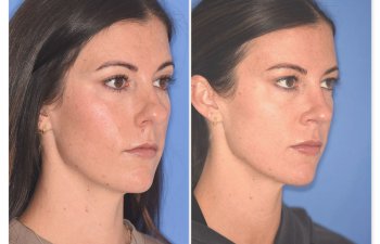 patient before and after rhinoplasty procedure