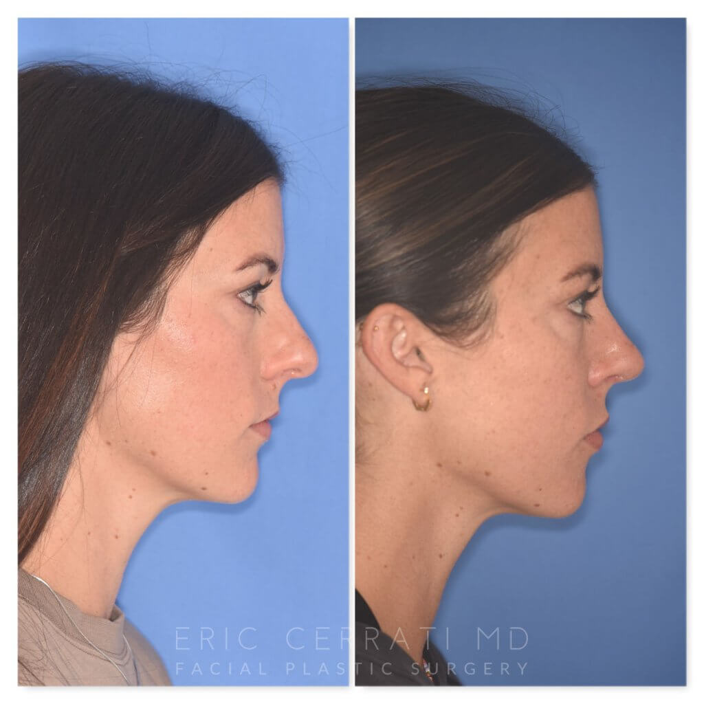 patient before and after rhinoplasty procedure