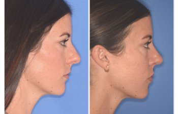 patient before and after rhinoplasty procedure