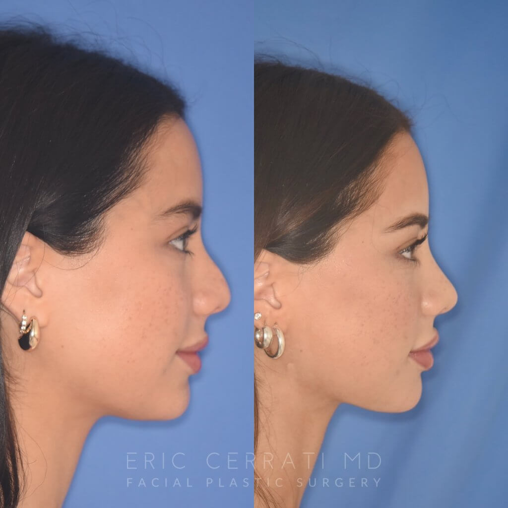 19 YR - 5 Months Postop: Rhinoplasty