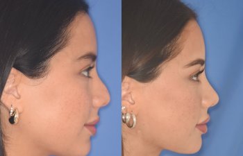 19 YR - 5 Months Postop: Rhinoplasty
