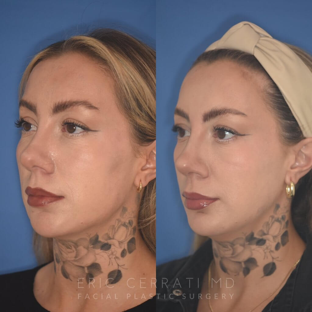 36 YR - 2 Months Postop: rhinoplasty & chin implant