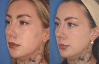 36 YR - 2 Months Postop: rhinoplasty & chin implant