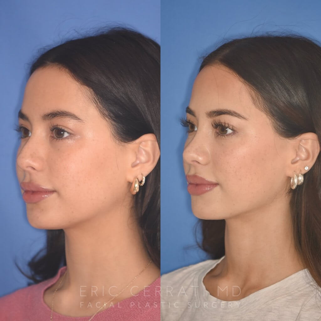 19 YR - 5 Months Postop: Rhinoplasty