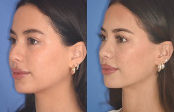 19 YR - 5 Months Postop: Rhinoplasty