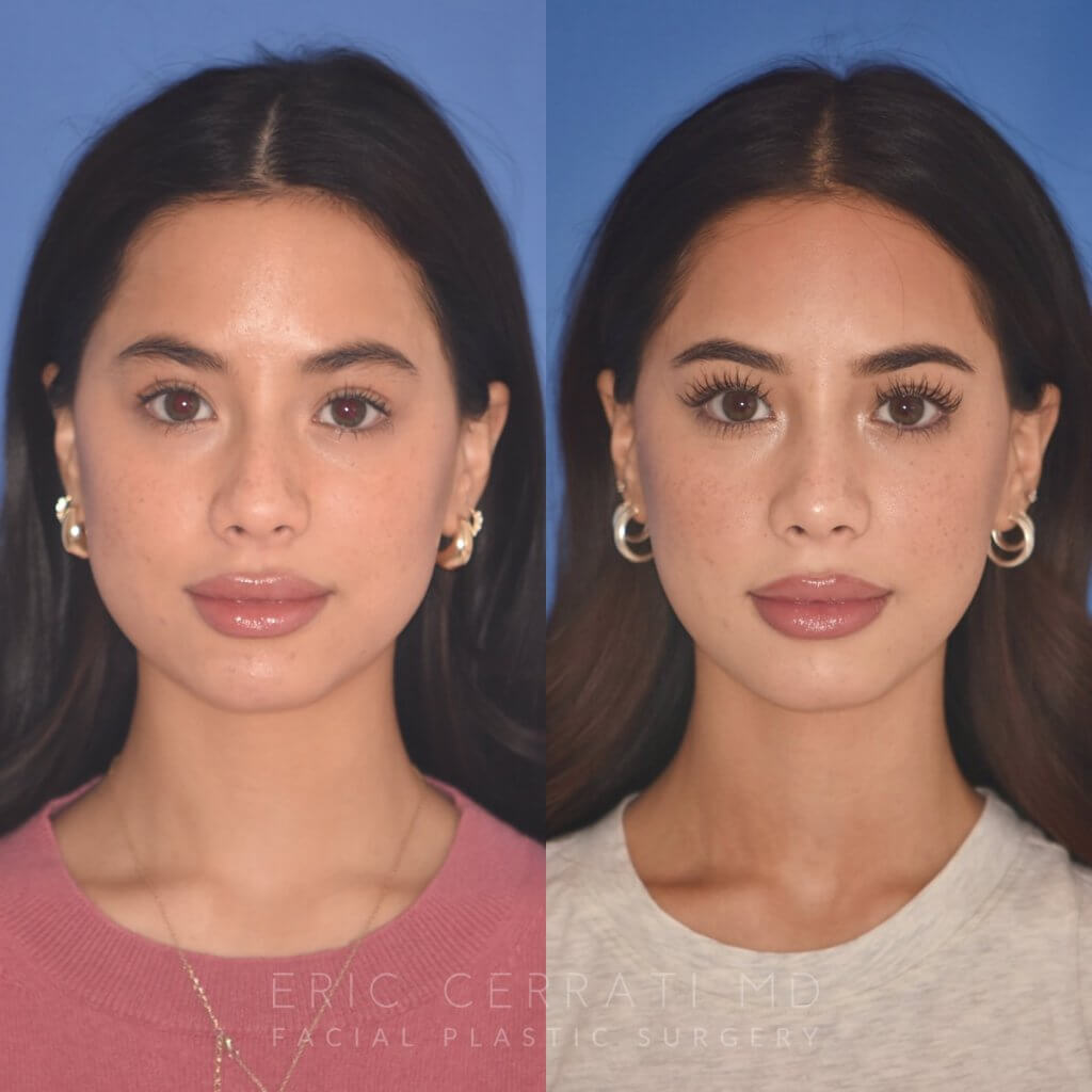 19 YR - 5 Months Postop: Rhinoplasty