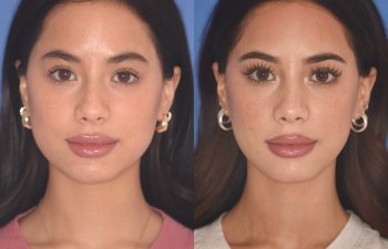 19 YR - 5 Months Postop: Rhinoplasty