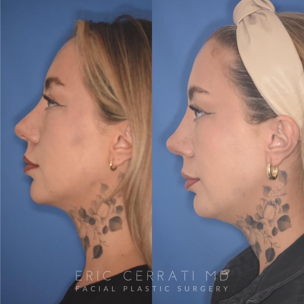 36 YR - 2 Months Postop: rhinoplasty & chin implant