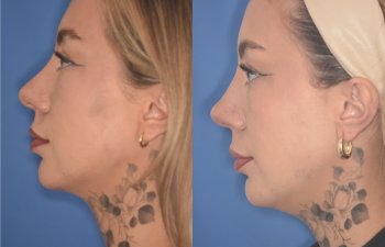 36 YR - 2 Months Postop: rhinoplasty & chin implant