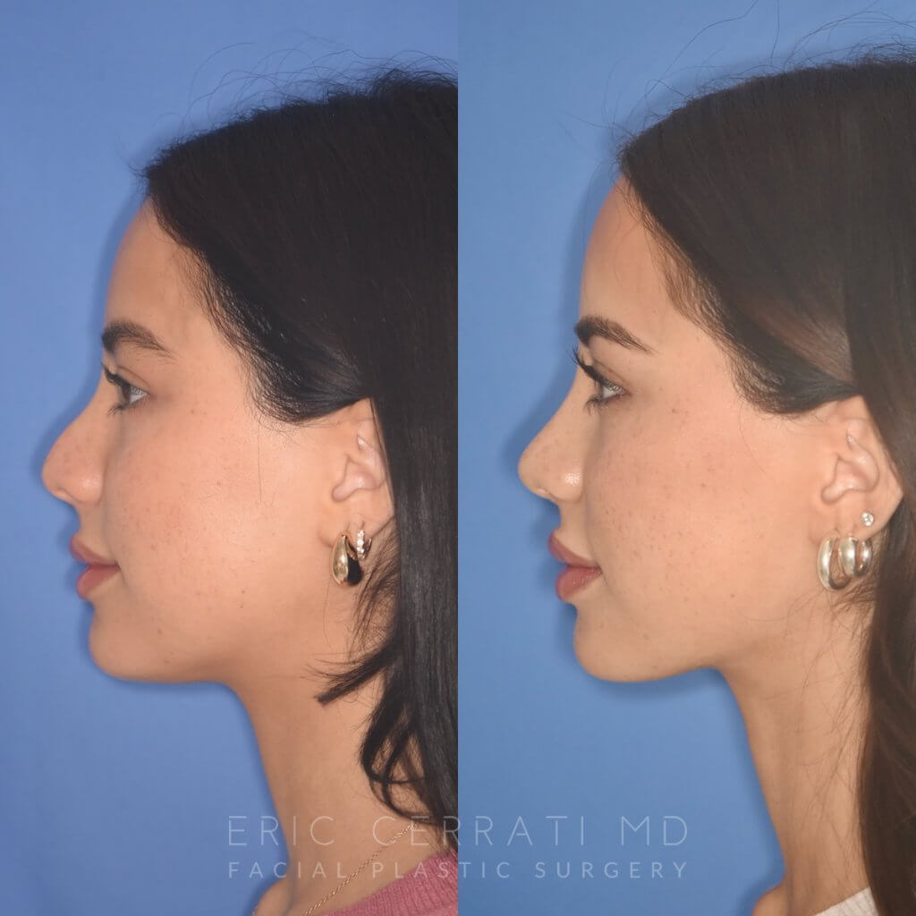 19 YR - 5 Months Postop: Rhinoplasty