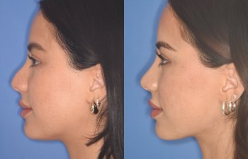19 YR - 5 Months Postop: Rhinoplasty