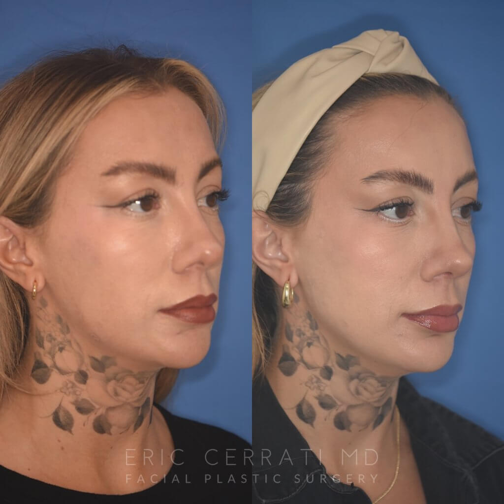 36 YR - 2 Months Postop: rhinoplasty & chin implant