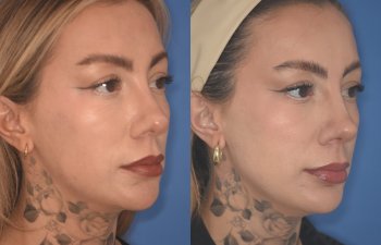 36 YR - 2 Months Postop: rhinoplasty & chin implant