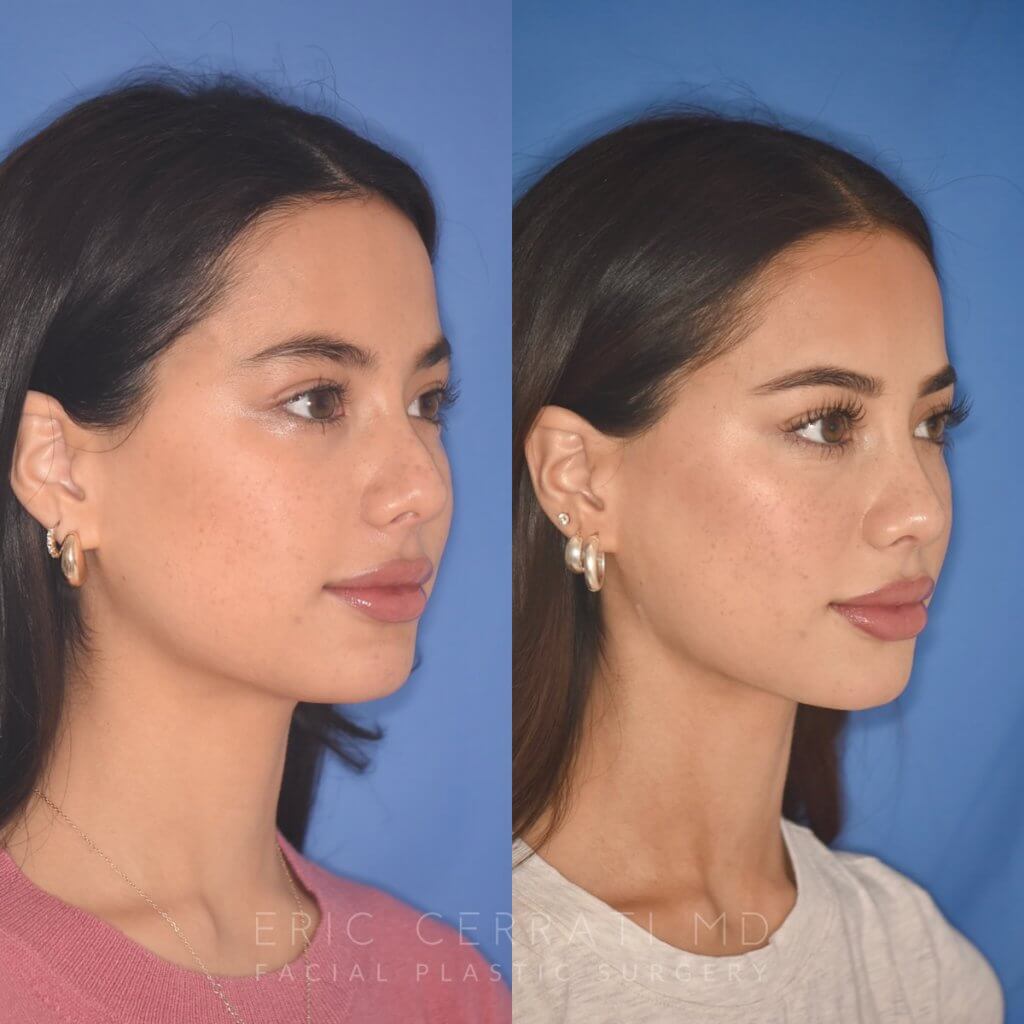 19 YR - 5 Months Postop: Rhinoplasty