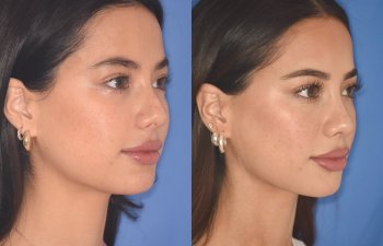 19 YR - 5 Months Postop: Rhinoplasty