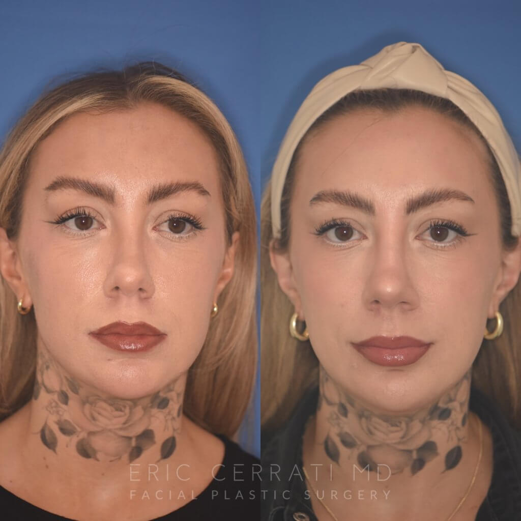36 YR - 2 Months Postop: rhinoplasty & chin implant