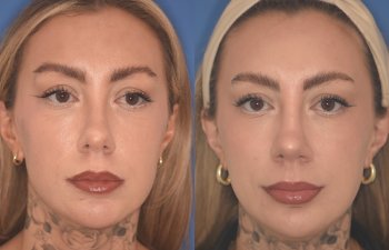 36 YR - 2 Months Postop: rhinoplasty & chin implant
