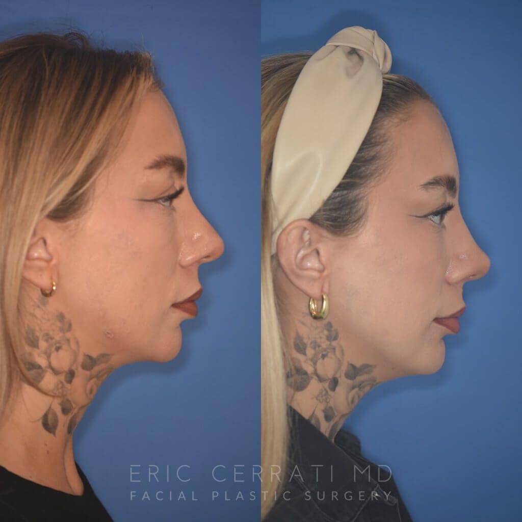 36 YR - 2 Months Postop: rhinoplasty & chin implant