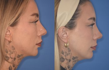 36 YR - 2 Months Postop: rhinoplasty & chin implant