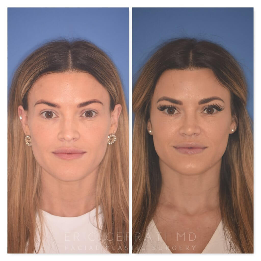32 YR - 2 Months Postop: Rhinoplasty