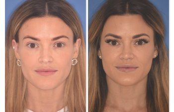 32 YR - 2 Months Postop: Rhinoplasty