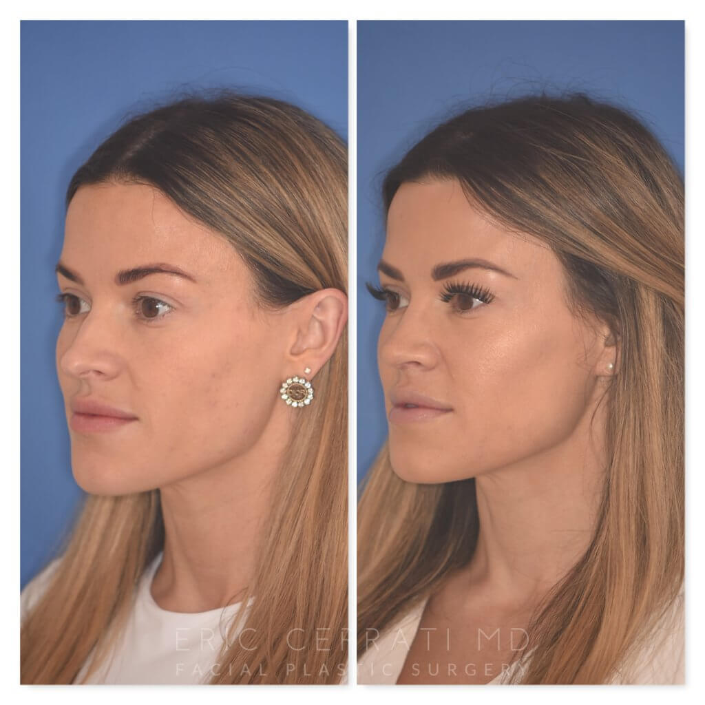 32 YR - 2 Months Postop: Rhinoplasty