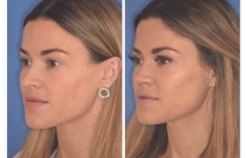32 YR - 2 Months Postop: Rhinoplasty