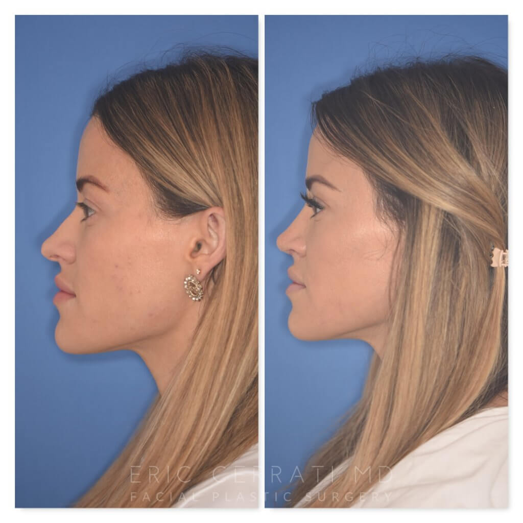 32 YR - 2 Months Postop: Rhinoplasty