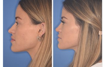 32 YR - 2 Months Postop: Rhinoplasty