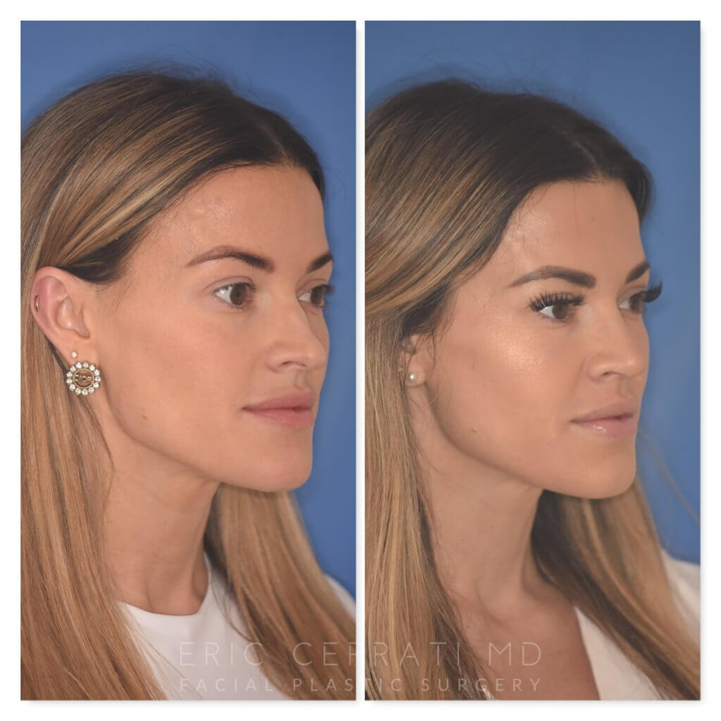 32 YR - 2 Months Postop: Rhinoplasty