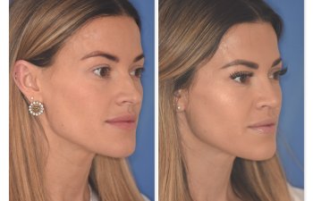 32 YR - 2 Months Postop: Rhinoplasty
