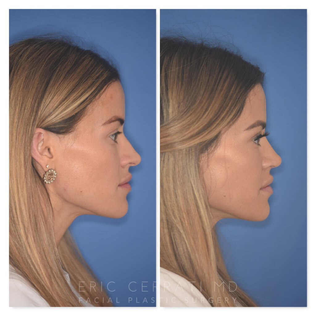 32 YR - 2 Months Postop: Rhinoplasty