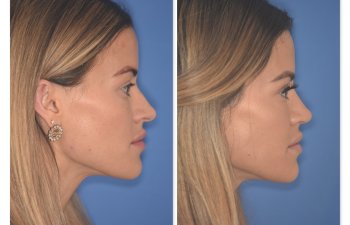 32 YR - 2 Months Postop: Rhinoplasty