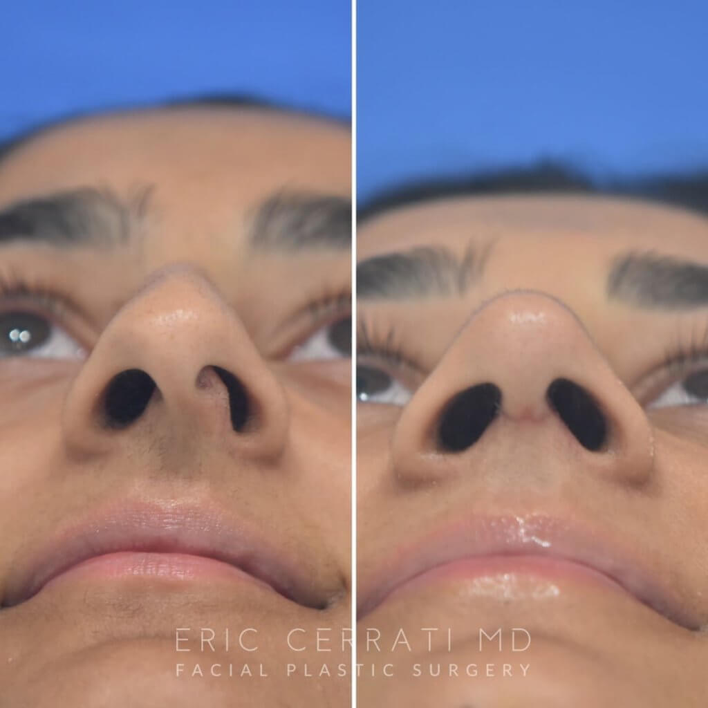 23 YR - 2 Months Postop: Rhinoplasty