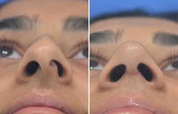 23 YR - 2 Months Postop: Rhinoplasty