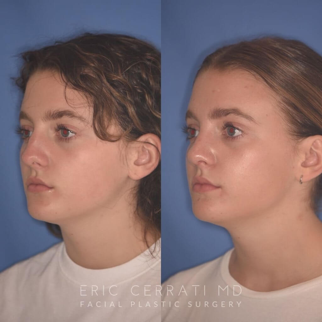 15 YR - 2 Months Postop: Rhinoplasty